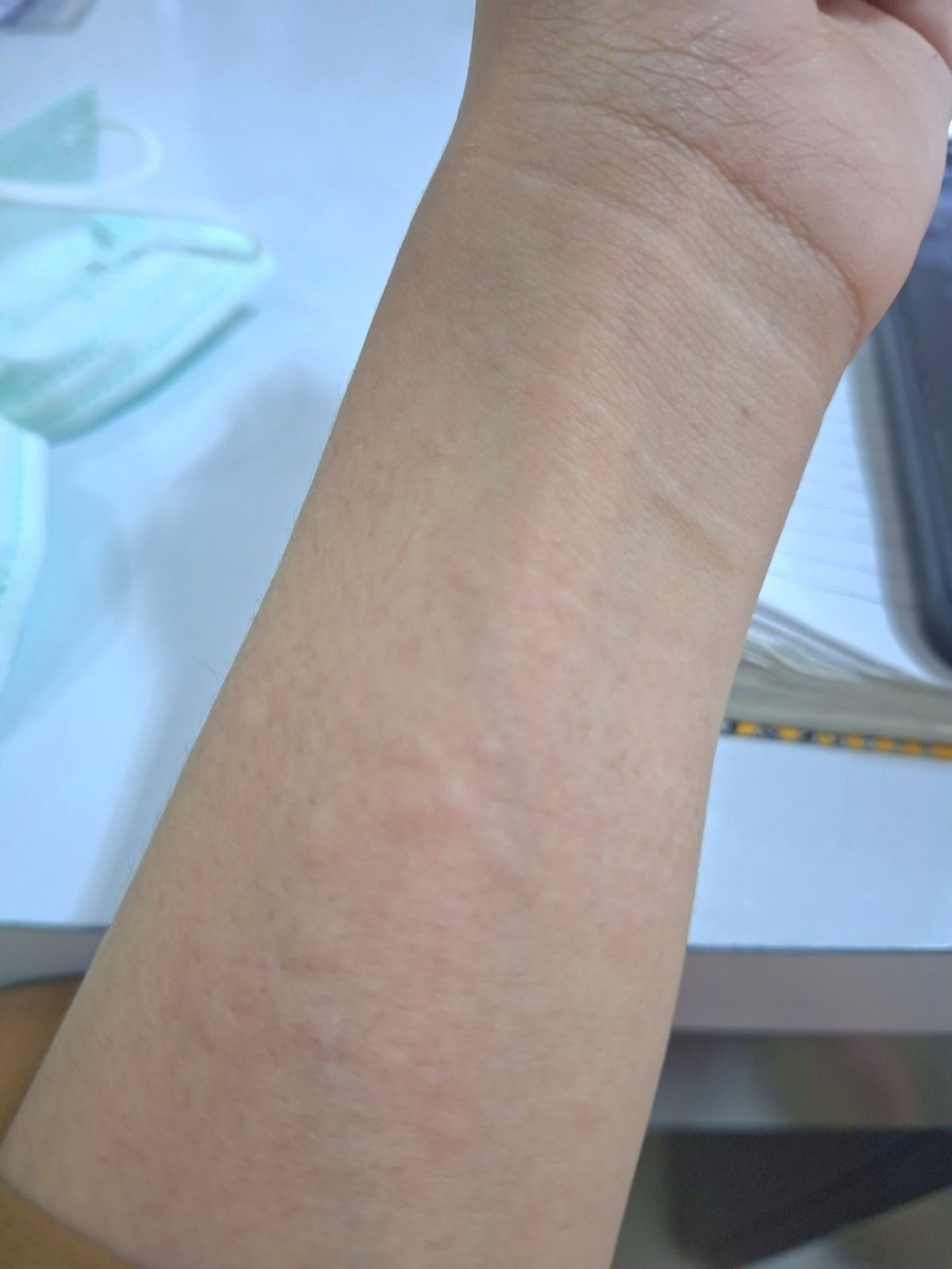 soojunx's tweet photo. Bolehkah gue mendiagnosis diri sendiri. Ini dermatitis kontak karena gue pake jam https://t.co/lOZhBCIIGG