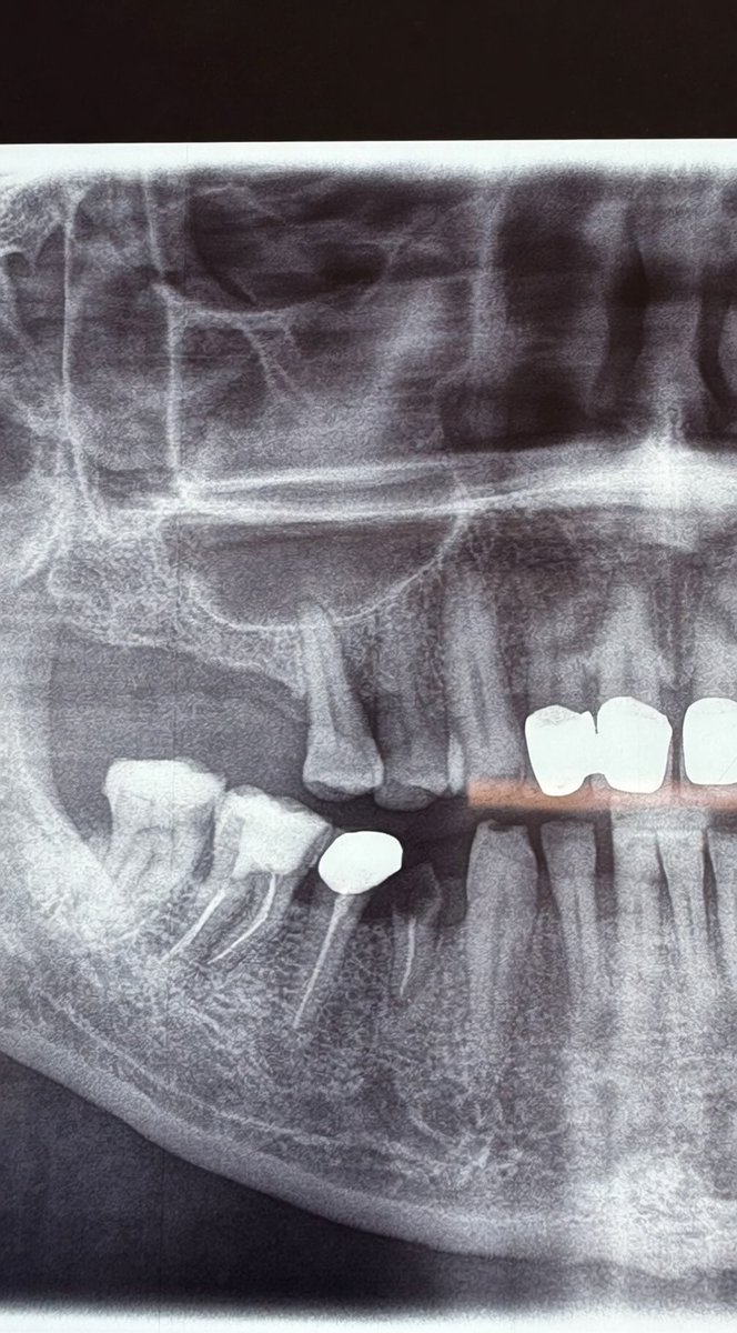 Wendy08034's tweet photo. Just another day saving smiles.  Root canals, crowns, and perfect bite alignment    all in one X, ray.  What looks crazy to most is art to us. Who else appreciates the beauty of a solid radiograph? #DentistLife #DentalRadiology https://t.co/GRB9Trpwwq