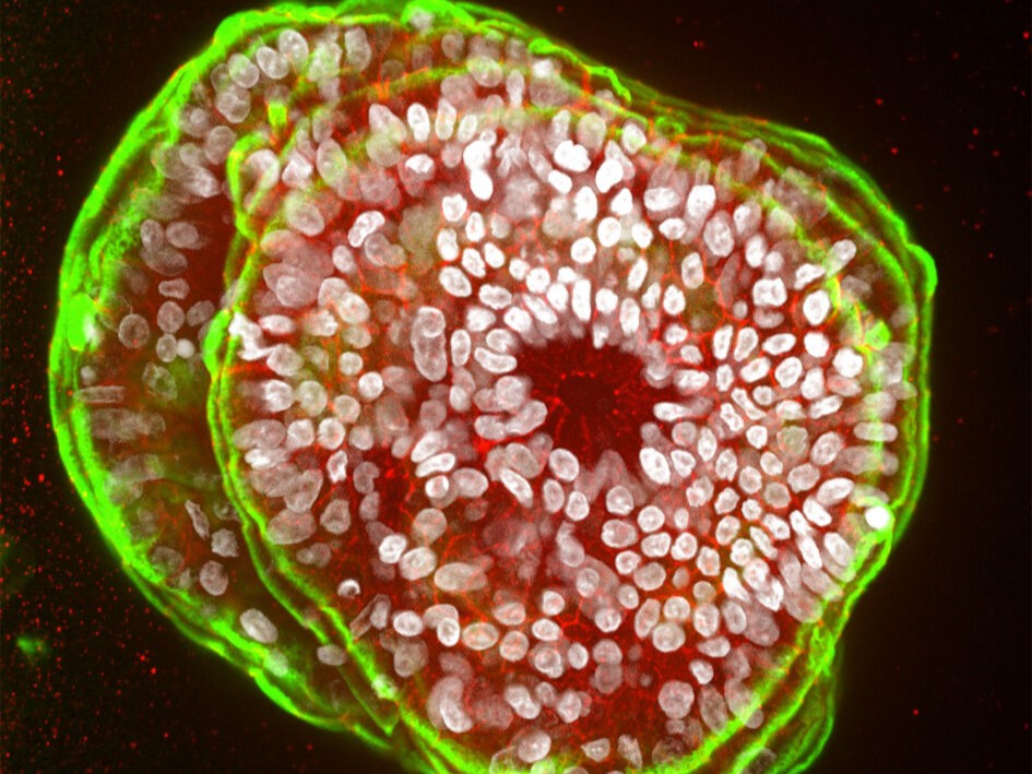 salkinstitute's tweet photo. What if doctors could test treatments on a mini version of your pancreas first? That's the promise of a personalized "disease-in-a-dish."

Salk scientists developed patient-derived pancreatic organoids—miniature pancreas models grown from a patient's own cells—that preserve the unique biology behind chronic pancreatitis.

Because the disease is driven by different molecular changes in different patients, therapies that work for one person may not work for another. Finding effective treatments has been especially difficult. Using this new platform, the researchers identified CFTR as a promising therapeutic target for many patients, bringing personalized treatment strategies one step closer.

Read more: https://t.co/Hpkkdd4z5T
#PrecisionMedicine #ChronicPancreatitis #Organoids #BiomedicalResearch #SalkInstitute