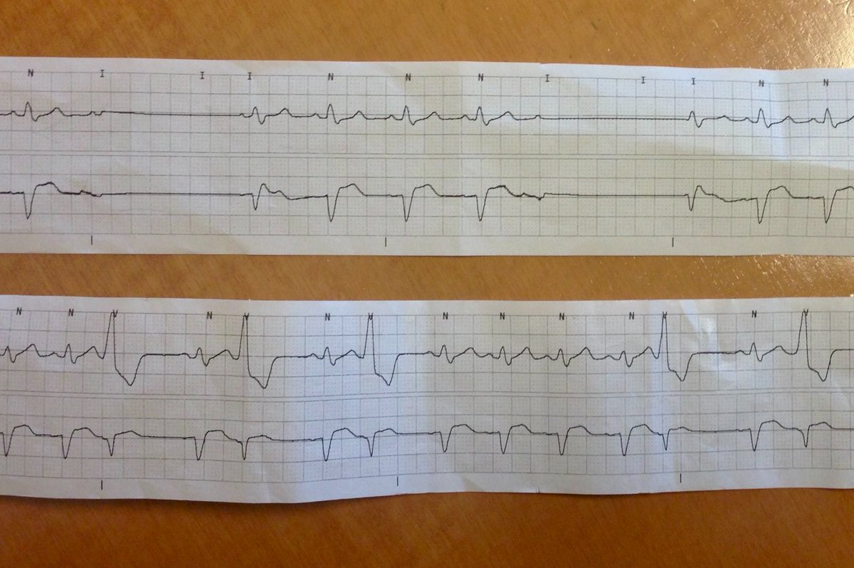 EhdaieMd's tweet photo. The following tele strip is obtained in a patient with dizzy spells. Metoprolol 25mg BID was started 12 hrs ago for PVCs.
Whats the next best step? Poll below π
(Courtesy of #CedarsSinaiEP fellows)
#CardioTwitter #Epeeps #EPfellows https://t.co/D0L3gVCofS