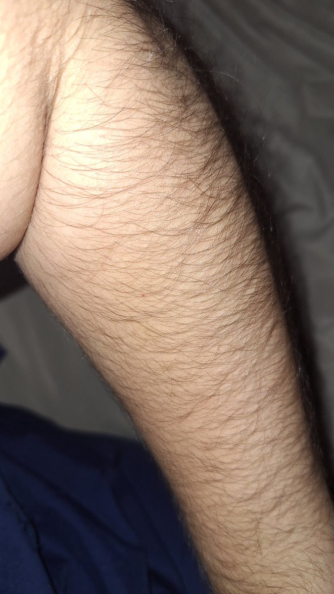 Ennaa_13's tweet photo. @Vatuuuttobene @EIGHTSVOICE My legs and arms, and no, i dont have hormonal issues and im not trans. Im just a hairy girl🧘‍♀️ https://t.co/c4PTsOe5wH
