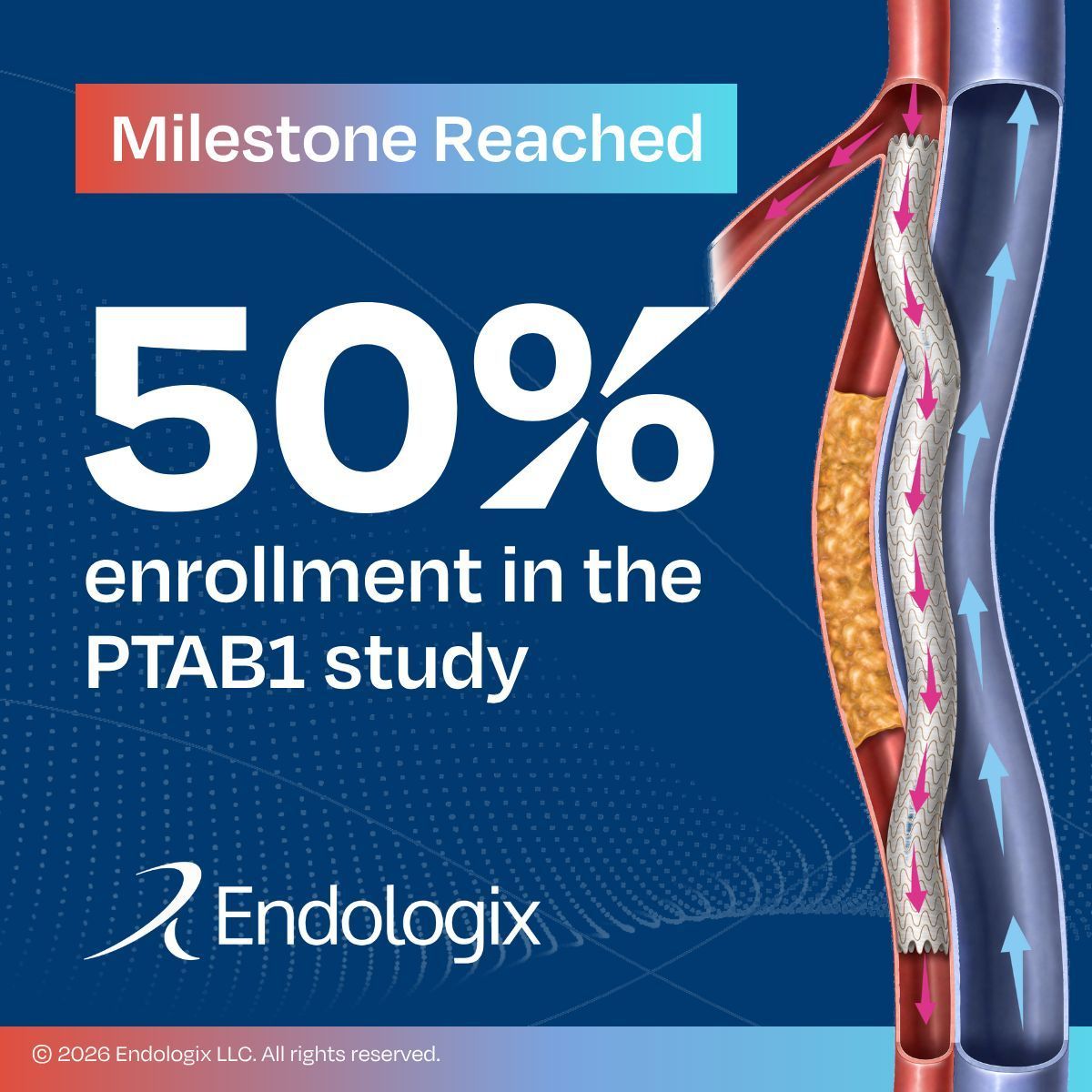 endologix's tweet photo. Exciting milestone for the PTAB1 study: 50% enrollment!

This real-world, post-approval registry is evaluating the long-term safety and effectiveness of the #DETOURSystem in patients with complex #PAD. Key endpoints include 1-year patency (freedom from reintervention), 30-day major adverse events, and long-term clinical and imaging follow-up through 5 years.

Reaching this enrollment milestone brings us closer to understanding the long-term outcomes that will help inform the future of PAD patient care.

Learn about the DETOUR System here: https://t.co/ycFuGmcK9i

#endovascular #healthcareinnovation #cardiotwitter #medicalinnovation #PTAB