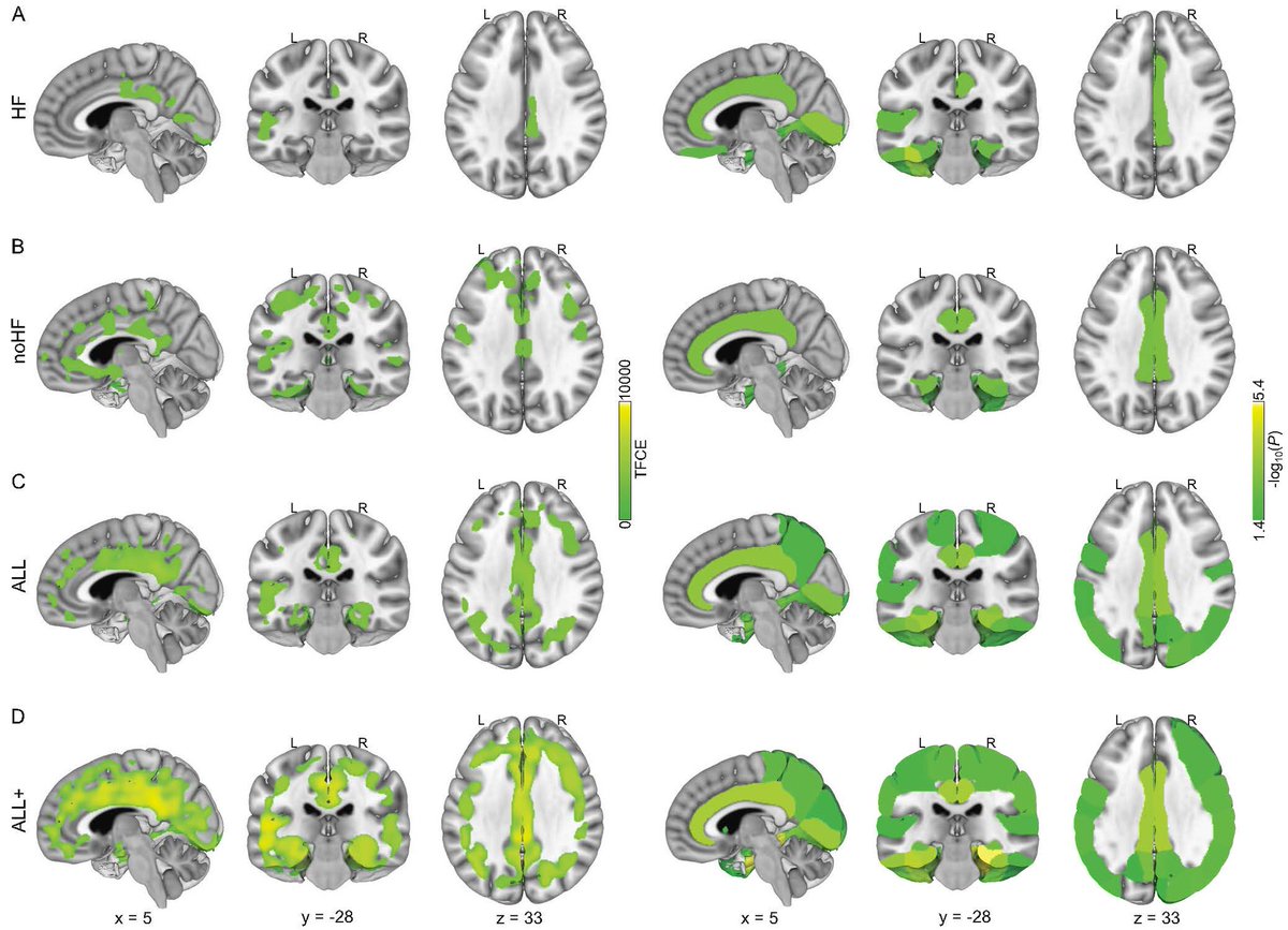 SfNJournals's tweet photo. New in #JNeurosci: Zhang et al. identify microstructural changes in the brain that may drive the link between cardiac dysfunction and memory deficits.
https://t.co/iR4YPno8Bi https://t.co/yrJBW1AGK4