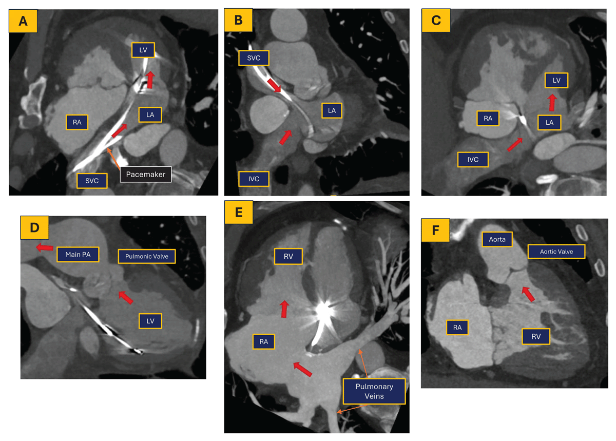DeBakeyCVedu's tweet photo. Advances in pediatric cardiology and surgery have led to more adults with CHD

The Initial Diagnostic Approach to ACHD: A Practical Imaging Pathway for General Cardiologists &amp; Cardiac Imagers @aliciarangosch @AneeshDhore @valeriaduarteMD

https://t.co/5ZKdMZ4uf6
#DeBakeyCVJournal https://t.co/BseZopxm3H