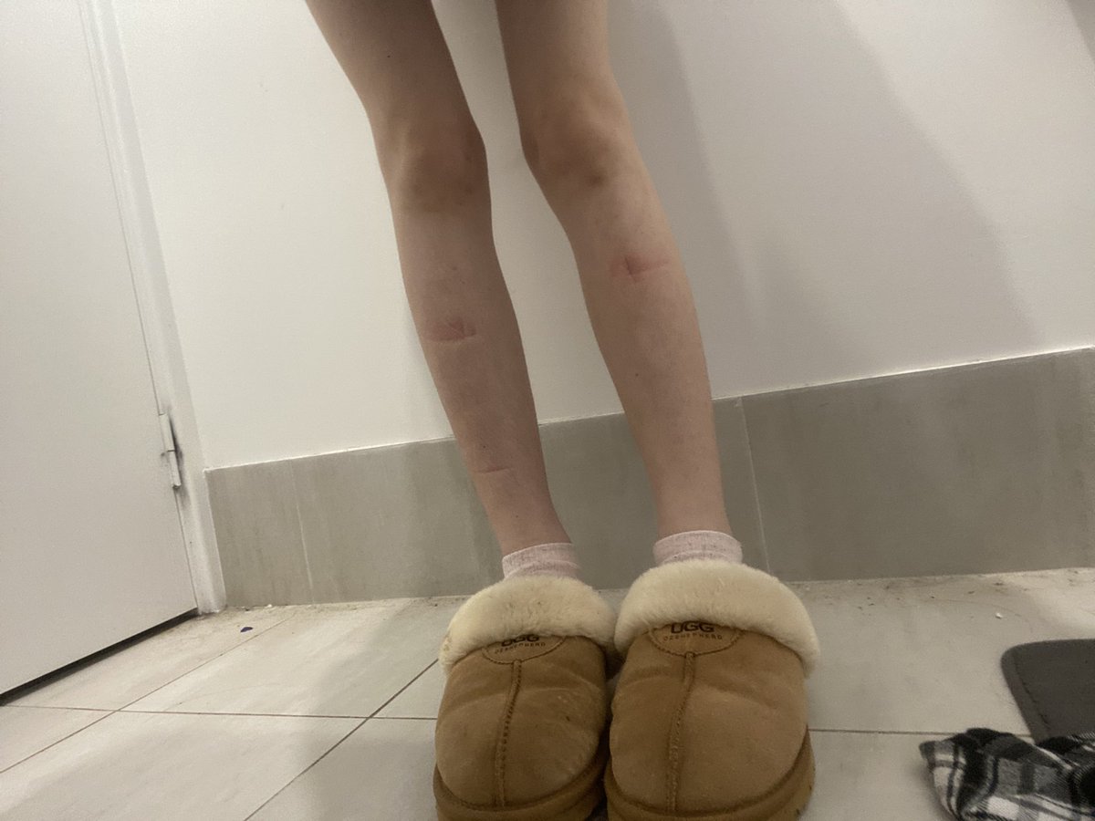 rotpilld's tweet photo. My legs always get red marks and bruises from being a chud and resting them on my desk #bodycheck #edtwt #edrtwt #thinspo #ricecaketwt #emotwt #scenetwt #shedtwt https://t.co/zGB8ZXUM3p