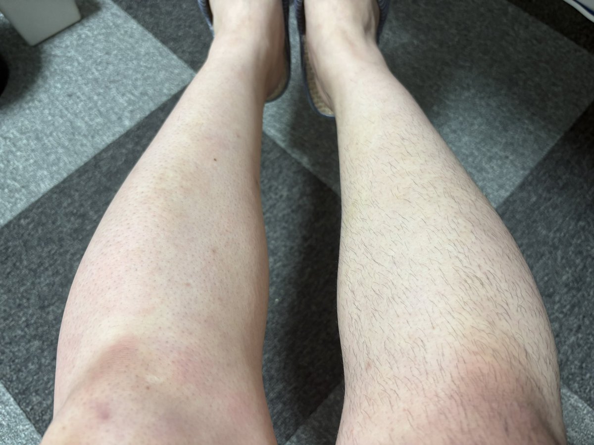 tntums_moru's tweet photo. TikTokで買った！！
そして毛も消えた！！www
しかし汚ぇ足だなぁ！！！ https://t.co/QjN1Dac1ho
