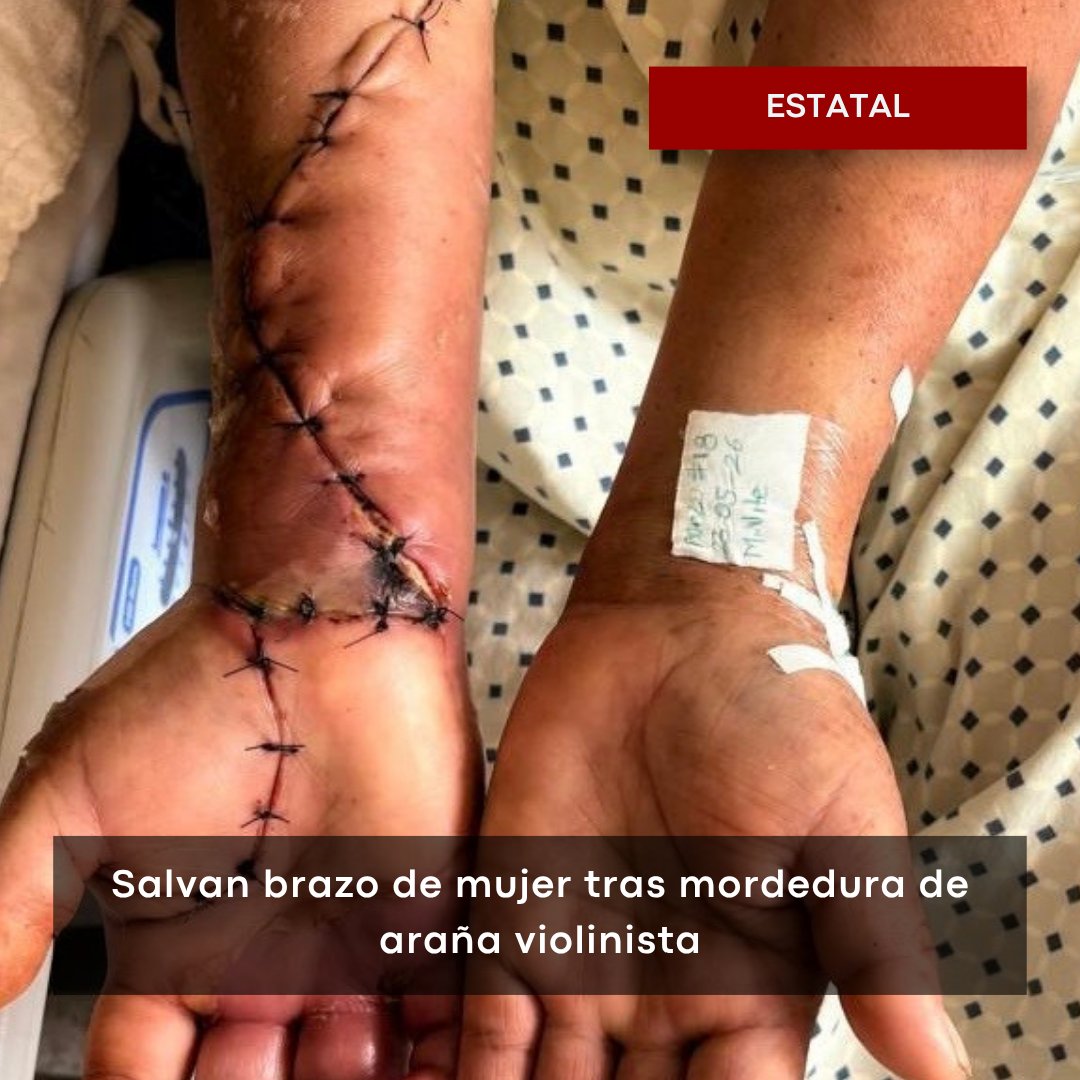 Transversal_hgo's tweet photo. Hazaña médica del #IMSSBienestar 🕷️🏥
Médicos especialistas lograron evitar la amputación del brazo derecho de una mujer tras la peligrosa mordedura de una #araña violinista. Gracias a una cirugía de urgencia y rehabilitación gratuita en #Apan y #Tulancingo, ¡logró conservar su extremidad!
Toda la historia: 👇🏼
https://t.co/RviXp50GjX