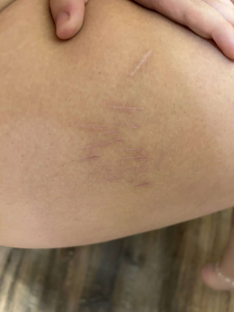 ST4RZST4RV3Z's tweet photo. 2nd oldest
-top/side of thigh
-styro https://t.co/b6TFoRx7c3