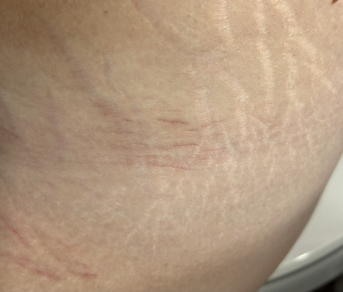 ST4RZST4RV3Z's tweet photo. Uhh idk I hate these
-hip/side
-catscratch ( w ONE styro) https://t.co/lPX4gnTHII
