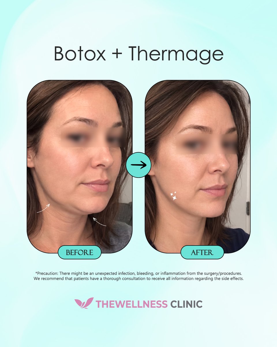 thewellnessen's tweet photo. Smoothing Fine Lines &amp; Lifting the Jawline ✨

Lock your contours into place! See how combining Thermage to deeply tighten sagging tissue into a crisp jawline frame with precision Botox to smooth out fine dynamic creases creates a beautifully lifted, refreshed look! 👇 https://t.co/qps3XqU9oG