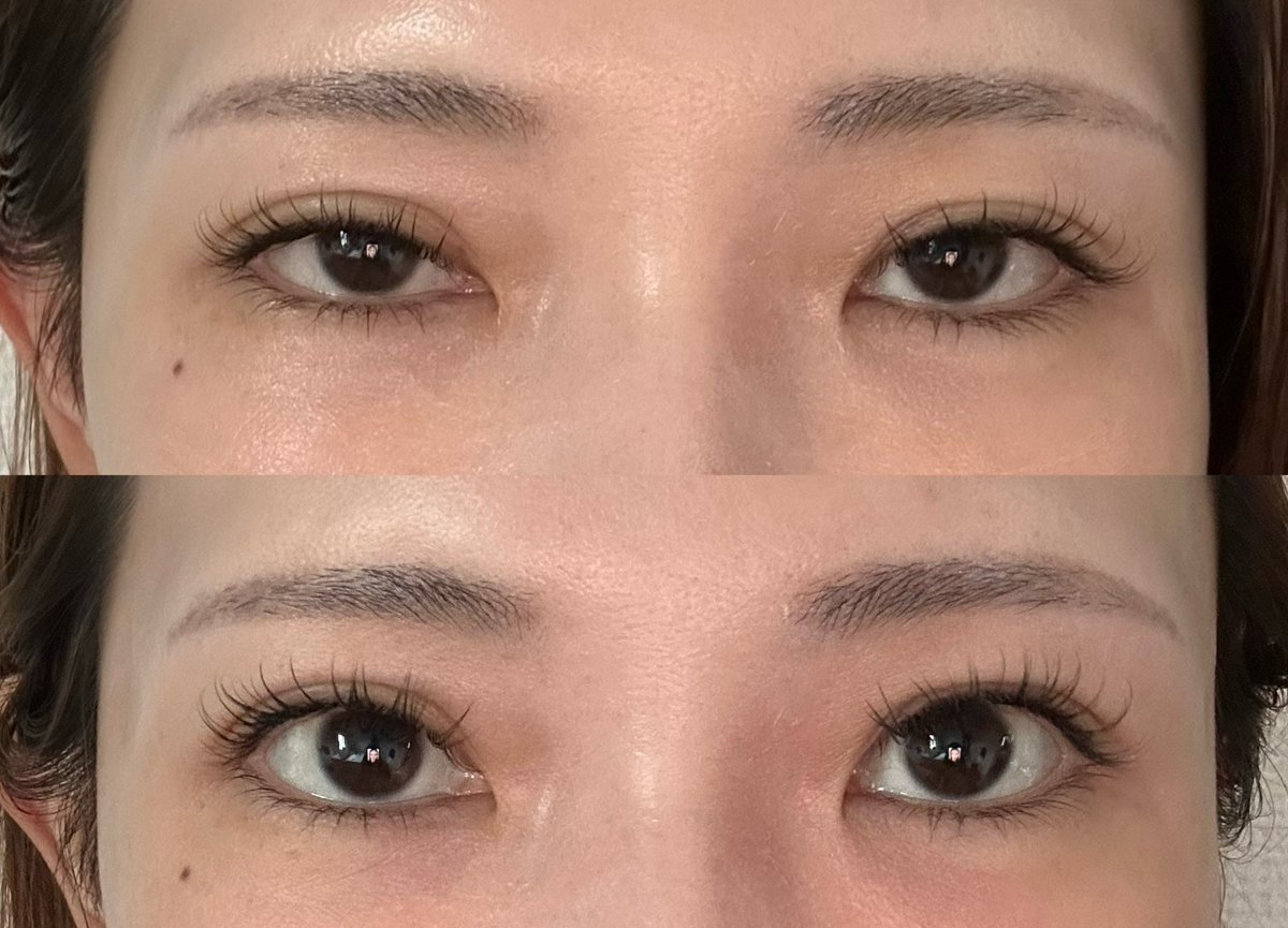 seikei31500's tweet photo. やばい‼️
眼瞼下垂改善の目薬すごい‼️
眠そうな目が自然に開いた
白い部分がより白くなって
目デカくなる‼️

@UBikebukuro 
UBクリニックで買ったよ
最初はお試しで10日分2000円購入 https://t.co/KB8uFHyUv8