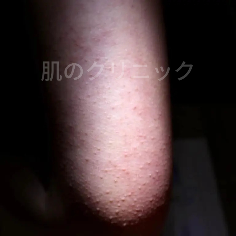 hadacli's tweet photo. 「二の腕のブツブツ」は、汚れでもニキビでもありません。

実は毛孔性苔癬（もうこうせいたいせん）という皮膚の状態です。

✔ 二の腕
✔ 太もも
✔ お尻
にできやすく、触るとザラザラ。

思春期に悪化しやすく、男女差はありませんが、美容上の問題から女性が受診するケースが多くみられます。 https://t.co/rWDDzSWg8A