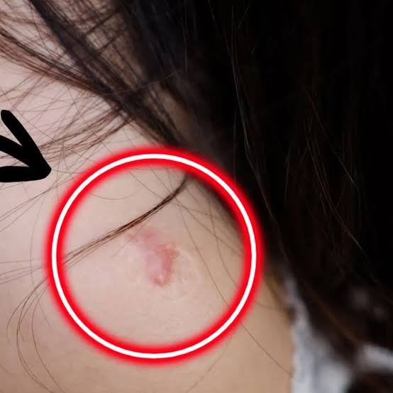 gilbertogt7's tweet photo. @WeriBomb Despues de Vacunarse, se forma una costra, esa costra al caerse dejaba esta pequeña cicatriz, al igual la cicatriz que queda en el hombro por la vacuna del sarampion https://t.co/RATEonqjpw
