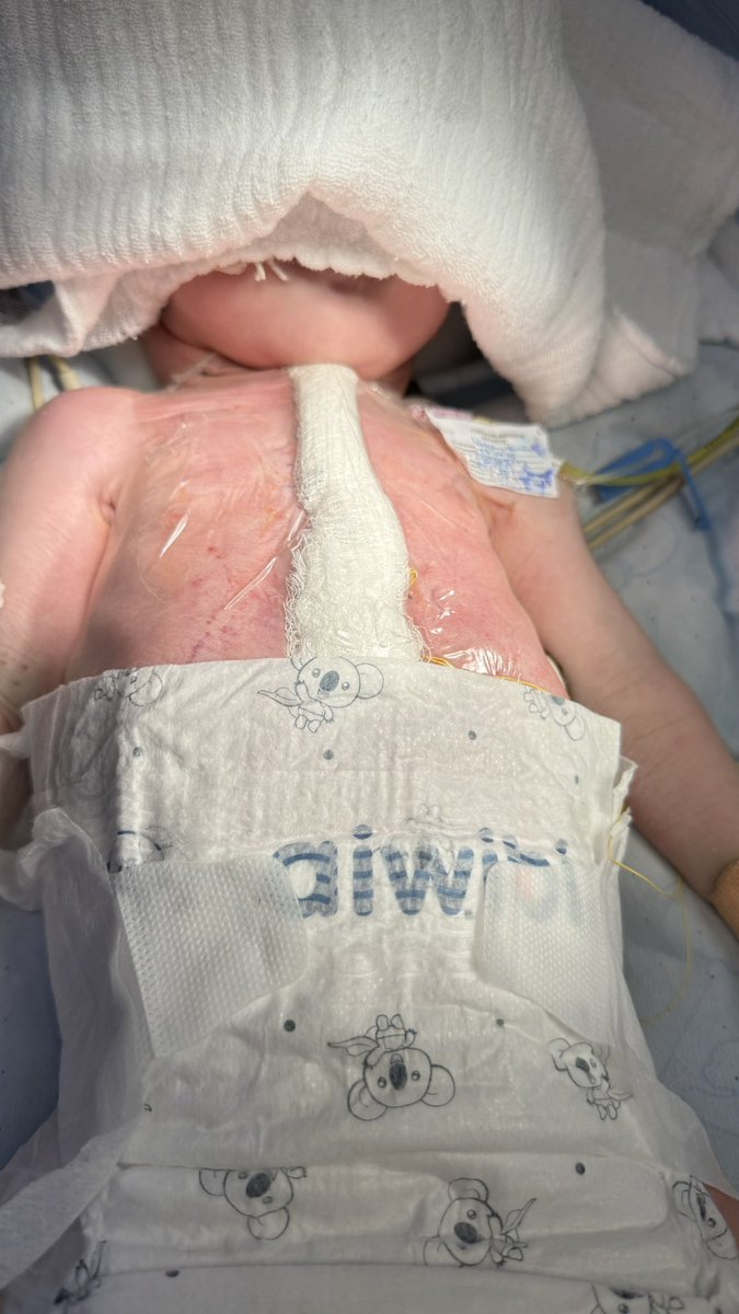 RUTWOLF's tweet photo. Cierre Esternal Exitoso &amp; Cirugía de Jatenne 
Hospital Especialidades Pediátricas 
Tuxtla Gutiérrez Chiapas México https://t.co/AeukQo1jro