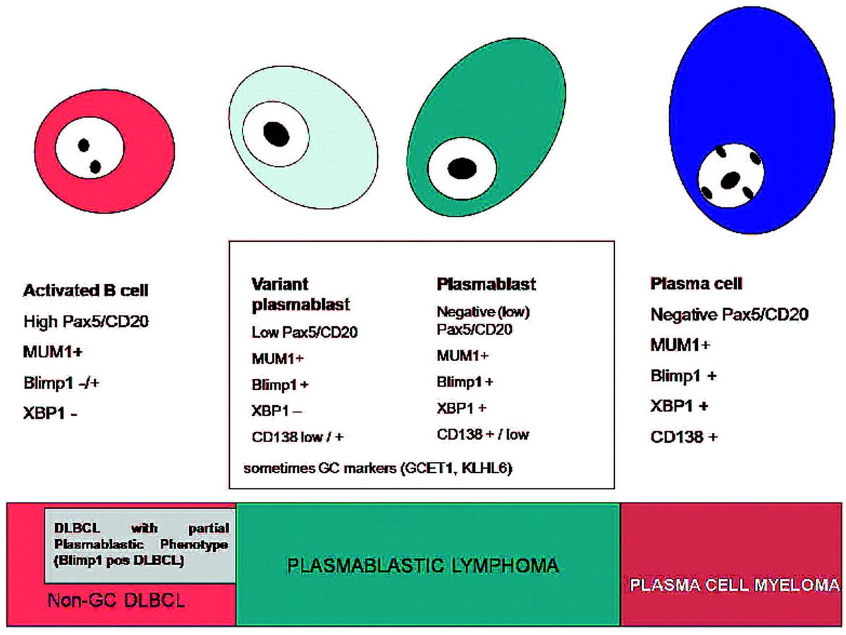 UyanikMehmetS's tweet photo. 📝 CD20 Negative Large B-Cell Lymphomas:
- Plasmablastic Lymphoma
- Primary Effusion Lymphoma
- HHV8 Associated Lymphoma
- ALK Positive LBCL https://t.co/7pCMPPudO3