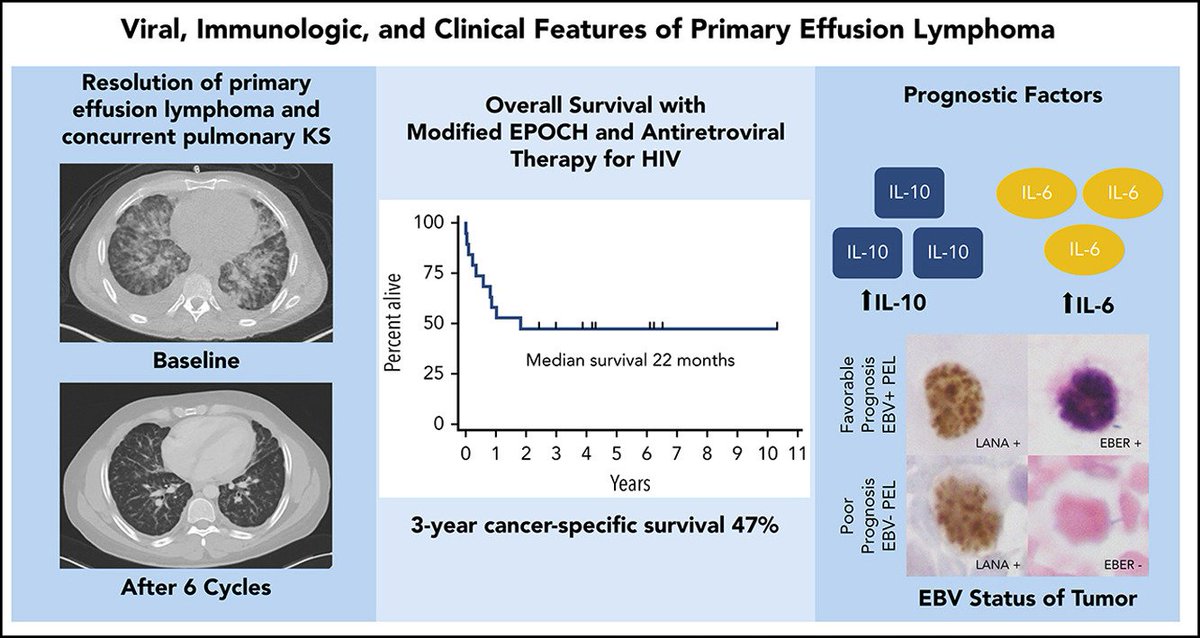 UyanikMehmetS's tweet photo. 📝 CD20 Negative Large B-Cell Lymphomas:
- Plasmablastic Lymphoma
- Primary Effusion Lymphoma
- HHV8 Associated Lymphoma
- ALK Positive LBCL https://t.co/7pCMPPudO3