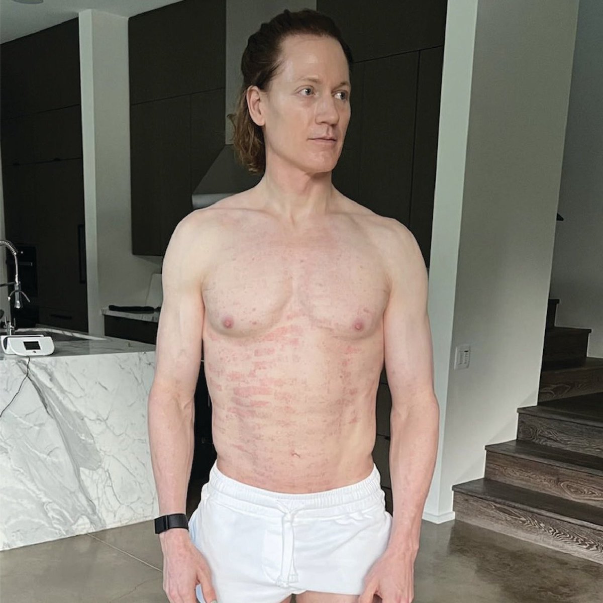 DrCamRx's tweet photo. CHOOSE YOUR HEALTH ROLE MODEL

Bryan Johnson:
- breaks ankle dancing
- autoimmune disorder from vegan diet
- zero athleticism
- sus &amp; pale

Erling Haaland:
- no broken bones
- healthy via ancestral diet: red/organ meat, fish, eggs, raw milk &amp; honey
- top footballer
- jacked &amp; tan https://t.co/u1enKkC7yf