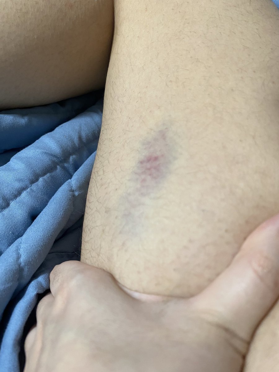 Coltstunts's tweet photo. just noticed this bruise.. it’s going to be bigger in the morning isn’t 

about the length of my pointer finger right now 😬ouch when did that happen https://t.co/x6e0dbEkii