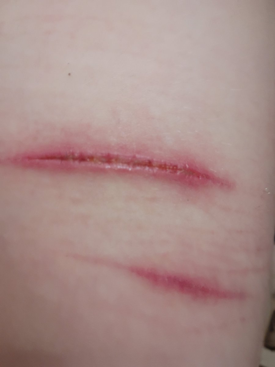 LoserNum's tweet photo. ... I think it's fine to finally post this. I feel less guilty about it now.

It's been over a week, why are they still so red? https://t.co/6ssBrF5Qyq