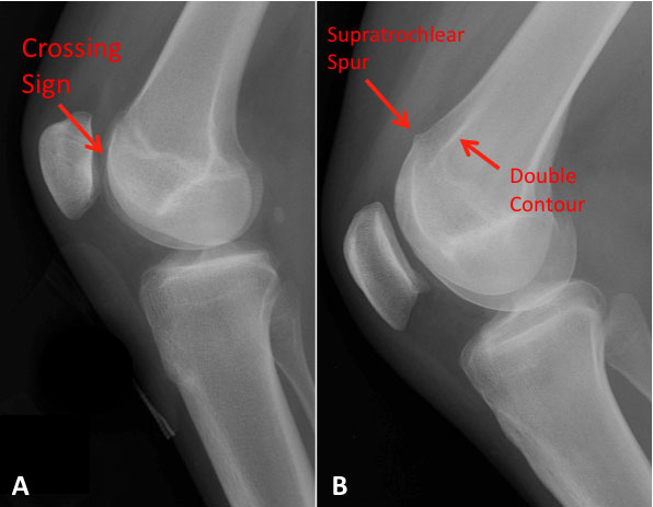 amarjunday's tweet photo. https://t.co/viTLby2zZP
trochlear dysplasia on xray 
#Radiology #Radres #FOAMrad https://t.co/3aTnTC7cDs
