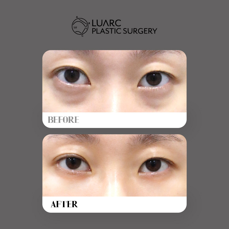 _luarcpsjp's tweet photo. "疲れて見える印象"を解消し、自然な若々しさを強調する文章です。

[本文]「疲れてる？」って聞かれる原因、実は目の下のクマ・たるみのせいかも？ 😭
年齢とともに、あるいは生まれつき目の下の脂肪がぷっくり膨らむと、その下に影ができて実年齢より老けて見えたり、暗い印象を与えたりしがちです。

当院の「目の下の切らないクマ・たるみ取り（脂肪再配置）」は、単に脂肪を除去するだけでなく、凸凹した脂肪を平らにならし、お顔全体の印象をパッと明るく健康的に改善する施術です。✨

✔ こんな方におすすめです

目の下がぷっくり 膨らんで影ができている方

クマがひどく、顔色が悪く見えやすい方

メイクでも目の下のたるみが隠しきれない方

目の周りの皮膚はとても薄く繊細なため、一人ひとりの脂肪の量や皮膚の弾力を見極め、丁寧にデザインすることが何よりも大切です。

鏡を見るたびに憂鬱だった目の下の影、当院の1:1オーダーメイドカウンセリングで、生き生きとした明るい目元を取り戻しませんか？ 🤍

💚お問い合わせ💚
✉LINE ID : @674hokfx
https://t.co/cYtVss3Dnr

#ルアク美容外科 #韓国美容 #リフティング #肌管理 #エルフ耳 #二重あご #美肌 #夏プロモーション