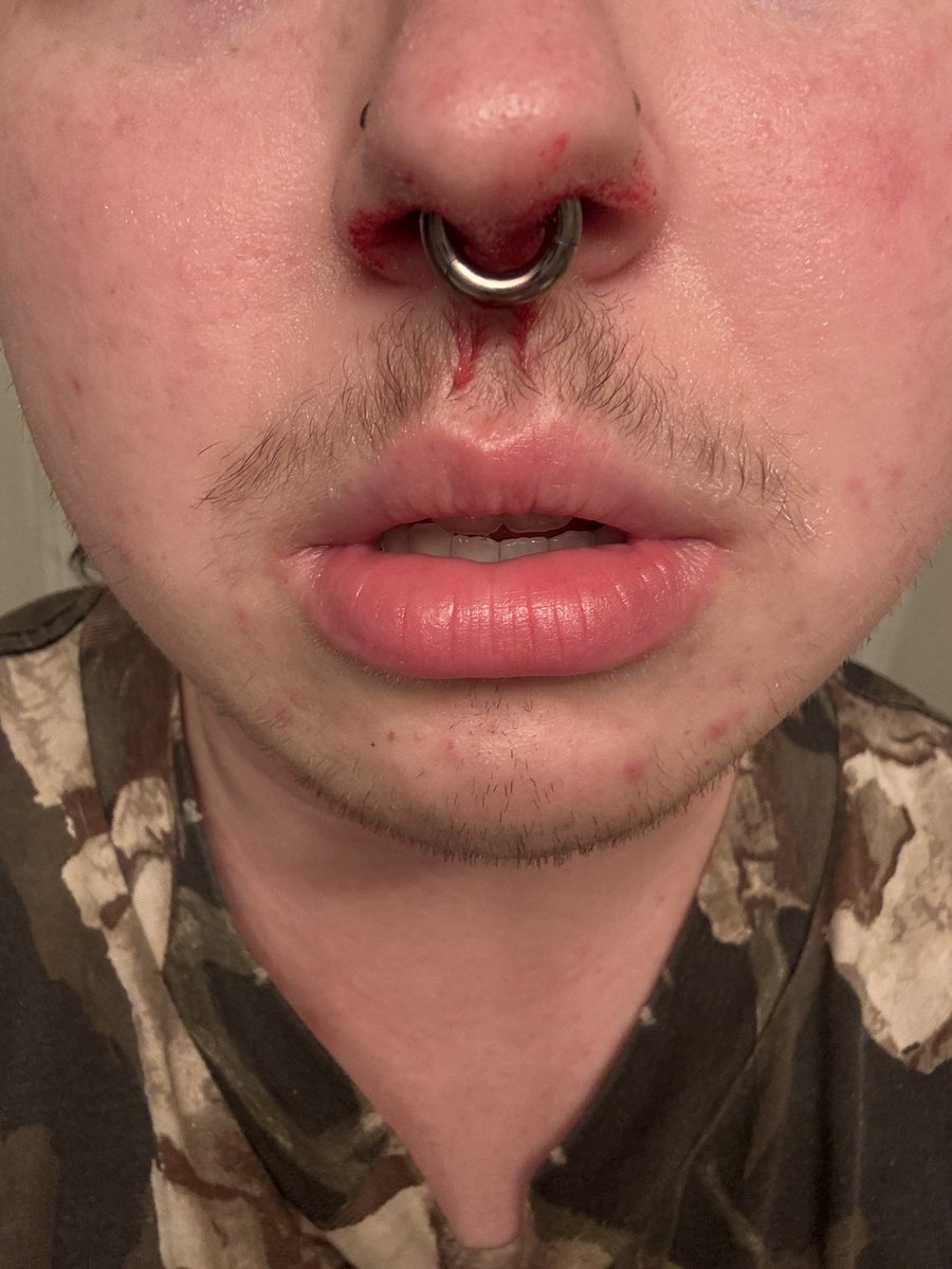 august_fangs01's tweet photo. damn got a bloody nose and for some reason I feel so sexy #ftm #genderfluid https://t.co/BT0Qjf754Y