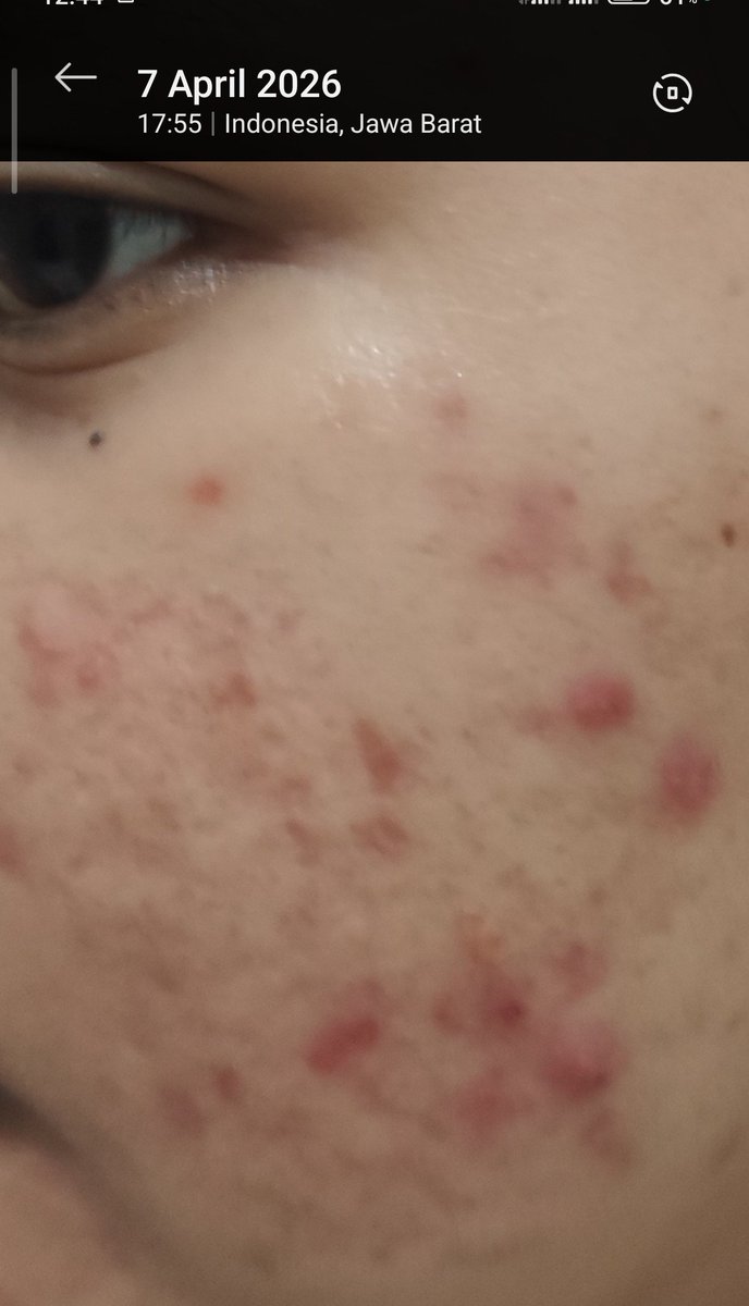 americano4sht's tweet photo. jujur jerawat gw brutal, apalagi kalo abis kalap makan manis 😭
udah coba banyak skincare tapi hasilnya gitu-gitu aja, sampe akhirnya beraniin coba produk APOTEK ini!!! https://t.co/WLXFKMM1e6