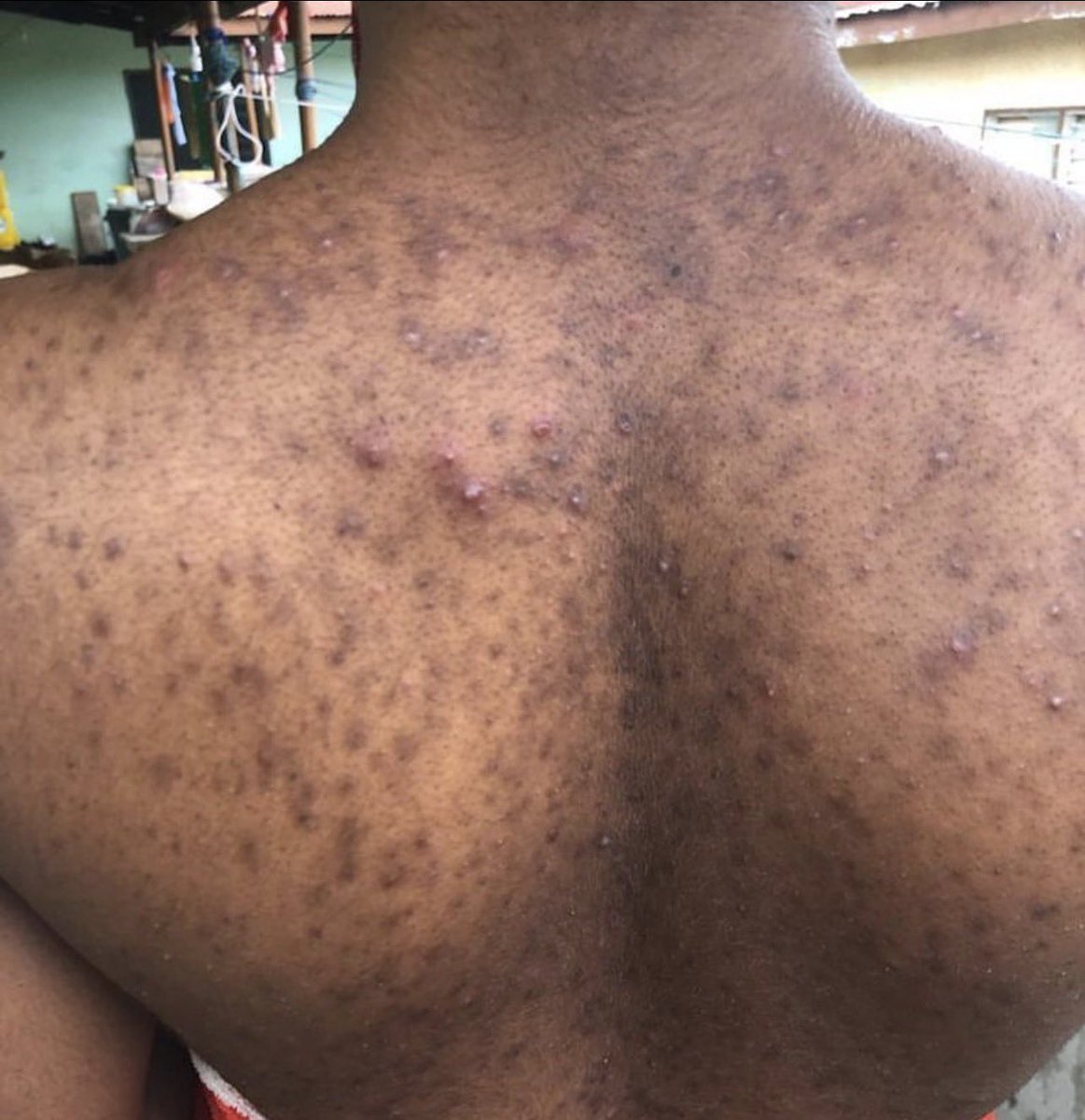 Baggio2345's tweet photo. A friend of mine has all this dark spot on his back and has tried a lot of medication but no changes. His gf left him because of this and he has been struggling looking for solutions here and there.
Please do anyone know any solutions to this or what causes it? Kindly share😔 https://t.co/tyQ9O24x9R