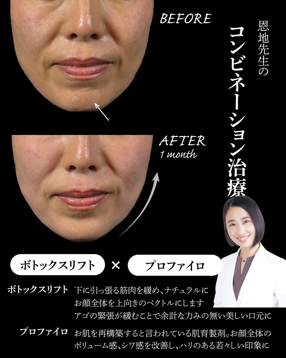 Rejuva3's tweet photo. 恩地先生の
≪コンビネーション治療≫

ボトックスリフトとプロファイロでナチュラルにエイジングケア
お肌にハリが出て、自然な若返り効果が見られます

エイジングケアは日々の積み重ねが大切！
何からはじめたらいいかわからない方、是非一度ご相談ください😌 https://t.co/uesodBDpEm