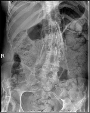 FabledFelts's tweet photo. @albertoortegana @THEMEDFACT23 Accurate! That x ray isn't FOP. FOP doesn't present as buckshot. https://t.co/KxxIX6fNFn