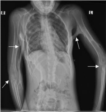 FabledFelts's tweet photo. @albertoortegana @THEMEDFACT23 Accurate! That x ray isn't FOP. FOP doesn't present as buckshot. https://t.co/KxxIX6fNFn