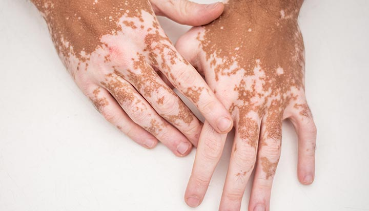 dogalmaxx's tweet photo. Vitiligo, genellikle bağışıklık sisteminin aniden kendi pigment hücrelerine (melanositlere) saldırarak onları yok ettiği gizemli ve çaresiz bir otoimmün hastalık olarak anlatılır.

Tedavi olarak da cildi incelten kortizonlu kremler veya ağır bağışıklık baskılayıcılar verilir. ++ https://t.co/JKc8XsUWBM