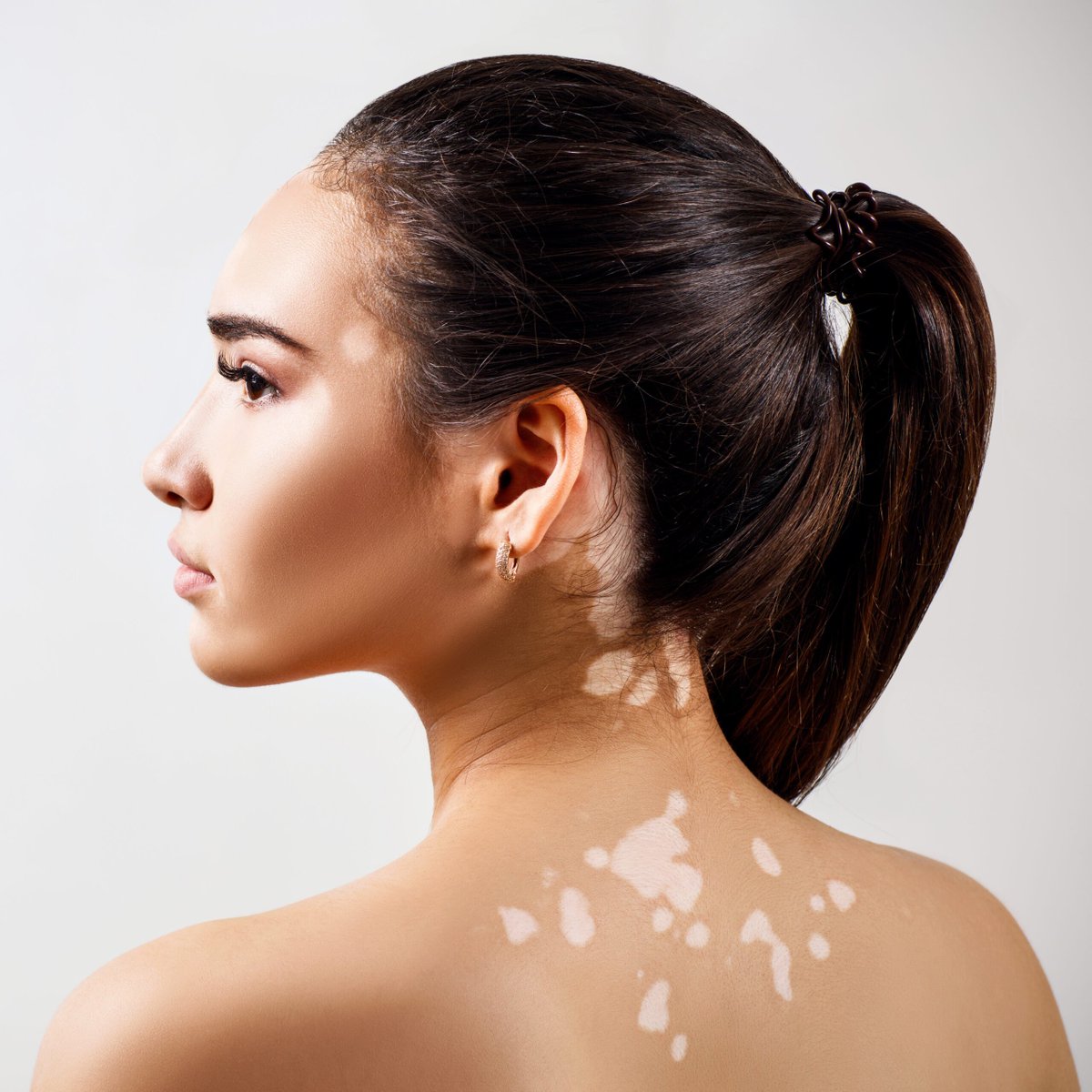 dogalmaxx's tweet photo. Vitiligo, genellikle bağışıklık sisteminin aniden kendi pigment hücrelerine (melanositlere) saldırarak onları yok ettiği gizemli ve çaresiz bir otoimmün hastalık olarak anlatılır.

Tedavi olarak da cildi incelten kortizonlu kremler veya ağır bağışıklık baskılayıcılar verilir. ++ https://t.co/JKc8XsUWBM