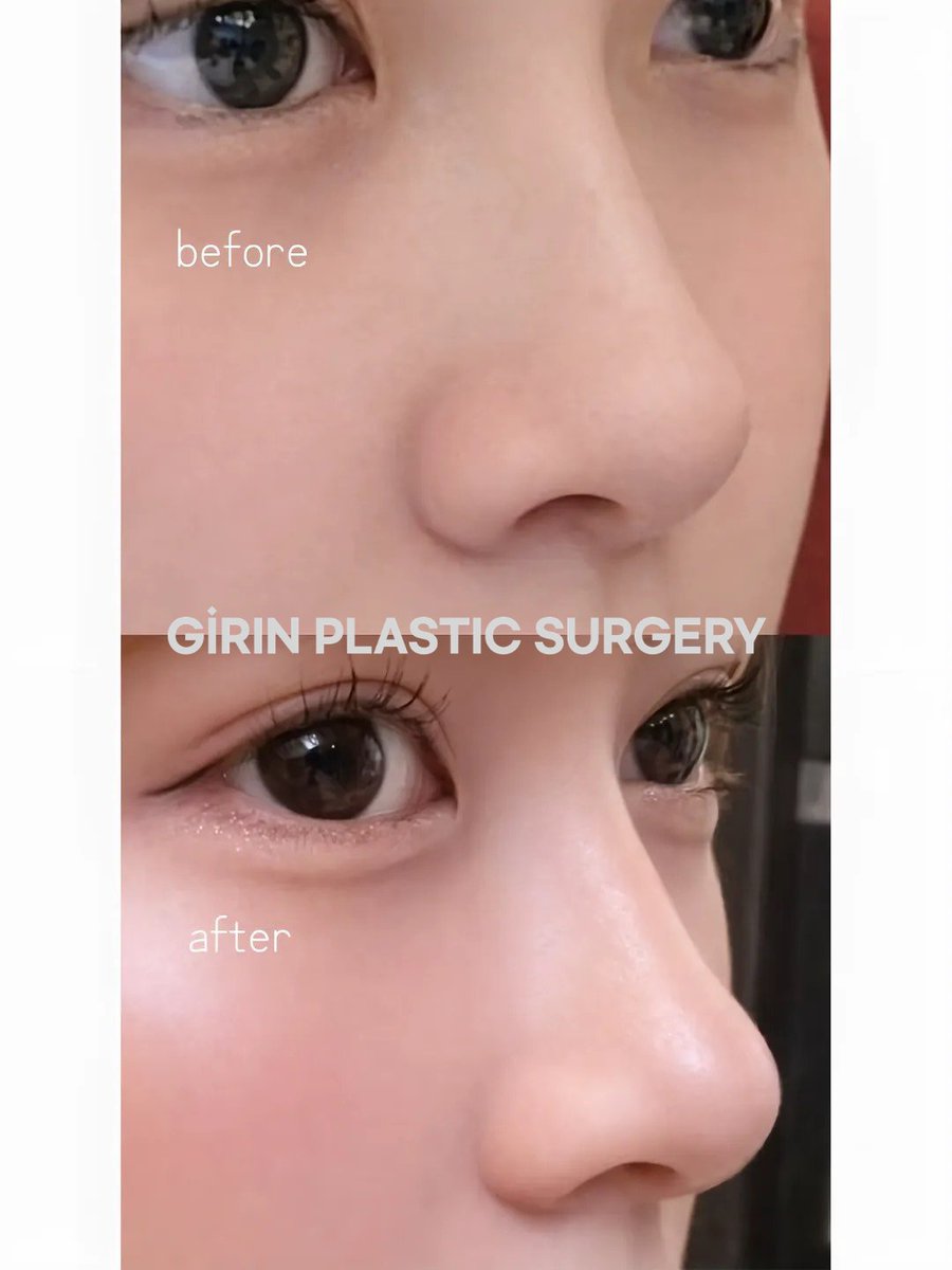 girinjp's tweet photo. 「高い鼻」よりも、
自分の顔に似合う鼻が一番大切✨

ただ高さを出すだけでは、
本当に自然な鼻にはなりません。

お顔全体のバランスや皮膚の厚み、
鼻先の土台までしっかり考えることで、
長く自然な仕上がりを目指すことができます🤍

ギリン美容外科の自家肋軟骨鼻整形は…

✔ お顔に合わせたオーダーメイドデザイン
✔ 安定感のある鼻先を実現
✔ ナチュラルで美しいライン
✔ 鼻の再手術もご相談可能

「整形した」と分かる鼻ではなく、
まるで元からそうだったような自然な美しさを✨

気になる方は、お気軽にDMまたはコメントでご相談ください💌

#ギリン美容外科 #自家肋軟骨鼻整形 #鼻整形 #鼻再手術 #韓国整形 #自然な鼻整形 #江南鼻整形 #江南美容外科