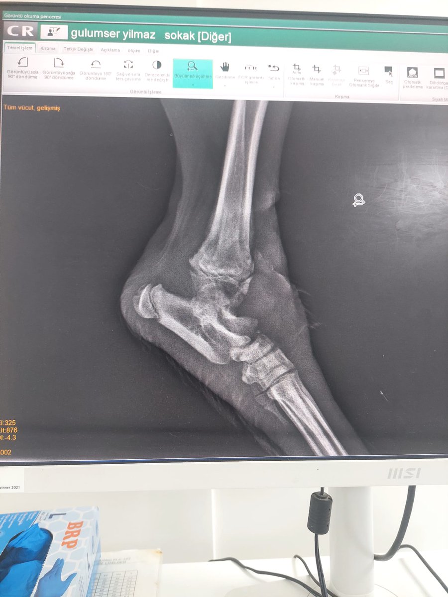 MiroNu21's tweet photo. 🚨 DRINGENDER SPENDENAUFRUF FÜR EINEN SCHWER VERLETZTEN WELPEN AUS ANTALYA 🚨

Heute erreichte mich ein Hilferuf aus Kepez/Antalya.

Die Tierschützerin Gülümser, die sich seit Jahren mit grossem Einsatz um Strassenhunde kümmert, fand diesen jungen Welpen mit einer schweren Verletzung am Hinterbein und brachte ihn sofort in die Varsak Veteriner Polikliniği.

Ich habe persönlich mit Gülümser und dem behandelnden Tierarzt gesprochen.

Die Diagnose ist erschütternd:

• Das Hinterbein ist gebrochen.
• Die Entzündungswerte sind sehr hoch.
• Der Welpe muss operiert werden und erhält eine Metallplatte.
• Da er sich noch im Wachstum befindet, könnte ein Handicap zurückbleiben.

Die geschätzten Behandlungskosten belaufen sich auf 40'000 TL. Die Klinik verlangte 20'000 TL Vorkasse, damit die Operation überhaupt durchgeführt werden kann.

Da dieser kleine Kämpfer nicht warten konnte, habe ich die 20'000 TL Vorkasse bereits an die Klinik überwiesen. Dafür habe ich schweren Herzens auf die Spenden zurückgegriffen, die ursprünglich für meine Halblöwen bestimmt waren. In diesem Moment zählte jede Minute, und ich wollte nicht riskieren, dass sich die Operation wegen fehlender finanzieller Mittel verzögert.

Gül und Basak aus Deutschland kennen und unterstützen Gülümser seit Jahren mit Futterspenden und stehen auch jetzt in direktem Kontakt mit ihr. Diesen Notfall können wir jedoch nicht alleine bewältigen.

Damit möglichst wenig durch PayPal-Gebühren verloren geht, werden die Spenden über das deutsche PayPal-Konto von Gül gesammelt. Von dort aus werden die Tierarztkosten direkt für diesen Welpen beglichen.

PayPal:
📧 guel_asik@yahoo.de

Jeder Euro hilft, die bereits geleistete Vorkasse auszugleichen und die weitere Behandlung dieses Welpen zu sichern.

Falls ihr nicht spenden könnt, helft bitte, indem ihr diesen Beitrag teilt. Gemeinsam können wir diesem kleinen Kämpfer die Chance auf ein schmerzfreies Leben schenken.

Von Herzen danke für eure Unterstützung. ❤️