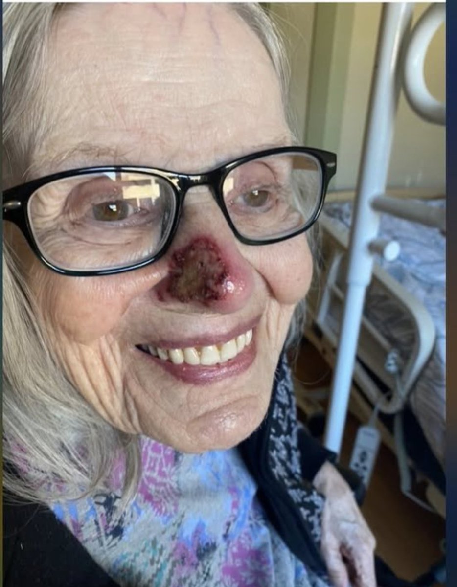 JoeTippen's tweet photo. I just had to share this. 🙌
My mom had this nasty spot on her nose. Skin cancer (SBCC). It kept getting worse.

They gave her Aldara cream – $650 out of our pocket. It barely helped.

I called my sister – she had Ivermectin cream prescribed for my nephew. She sent it to me.

Day 1:
I put it on her nose myself. The nursing home staff looked at me sideways. I didn't care.

Day 2:
I went back the next morning and couldn't believe my eyes.

The redness had already calmed down. The crusty spot was shrinking. It was like night and day.

I took a picture. Compared it to the day before. I almost cried.

Day 5:
Completely gone.

Just like that. A $250 tube of Ivermectin cream did what the $650 prescription couldn't.

Her nose is smooth. Clear. Like nothing was ever there.

Mom's doctor?
He was impressed. Couldn't believe it. He actually ordered a tube for the nurses to use if any other lesions pop up.

Ivermectin isn't just for parasites.
It's for skin cancer. For rosacea. For stubborn fungal infections. For all kinds of things the system won't tell you about.

Liquid. Paste. Pills. They all have their place.

I'm so grateful my mom is close by.
I can go in, monitor her, and be her advocate.

Some doctors don't recognize Ivermectin for skin cancer. But I knew it was worth a shot.

And here we are.

Praise The Lord. 🙏