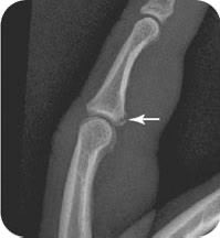 DrAyubaD's tweet photo. EASY ONE 🔥🔥

Patient with hyperextension injury to the finger and inability to flex at PIP joint.

Lateral X-ray of the finger.

Spot the abnormality? 👇

#MedX #Radiology #FOAMrad #MSK #Ortho https://t.co/FUcqmH2YJF