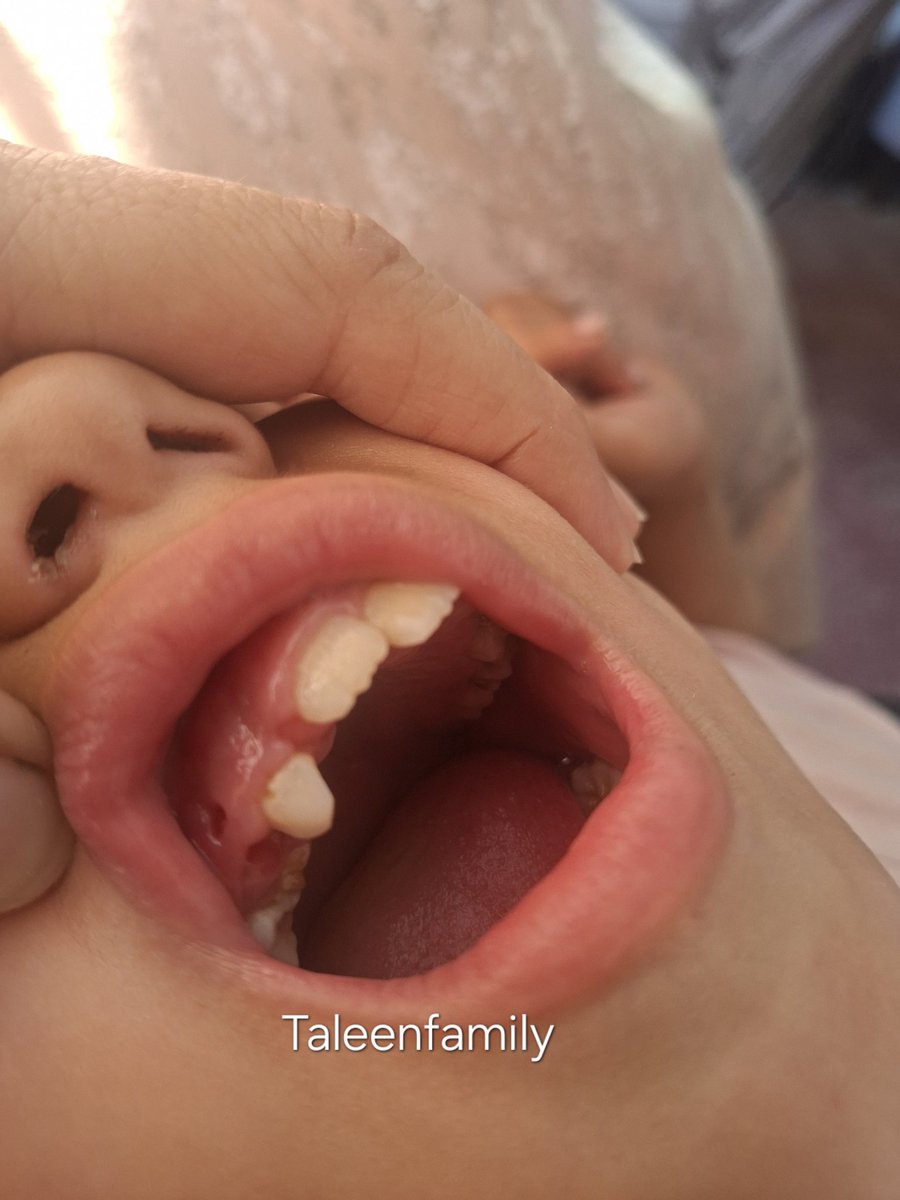 TaleenFamily's tweet photo. My daughter is in pain… and I can’t help her.
She is suffering from severe gum and tooth pain, crying all day and unable to sleep because of how intense it is 😔
Please, don’t leave her to suffer alone 💔
Any support—even something small—could ease her pain and help save her 🙏
If you can’t donate, please share this post or leave a comment… it might 
reach someone who can help 🤍
https://t.co/bQju4rWwcj
#HelpMyDaughter #Donate #SaveALife