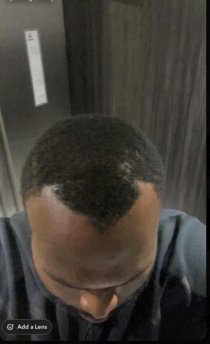 Topzycut's tweet photo. My client few years back before hair transplant vs now… a sign to invest in your look https://t.co/pOQoUl7SpY