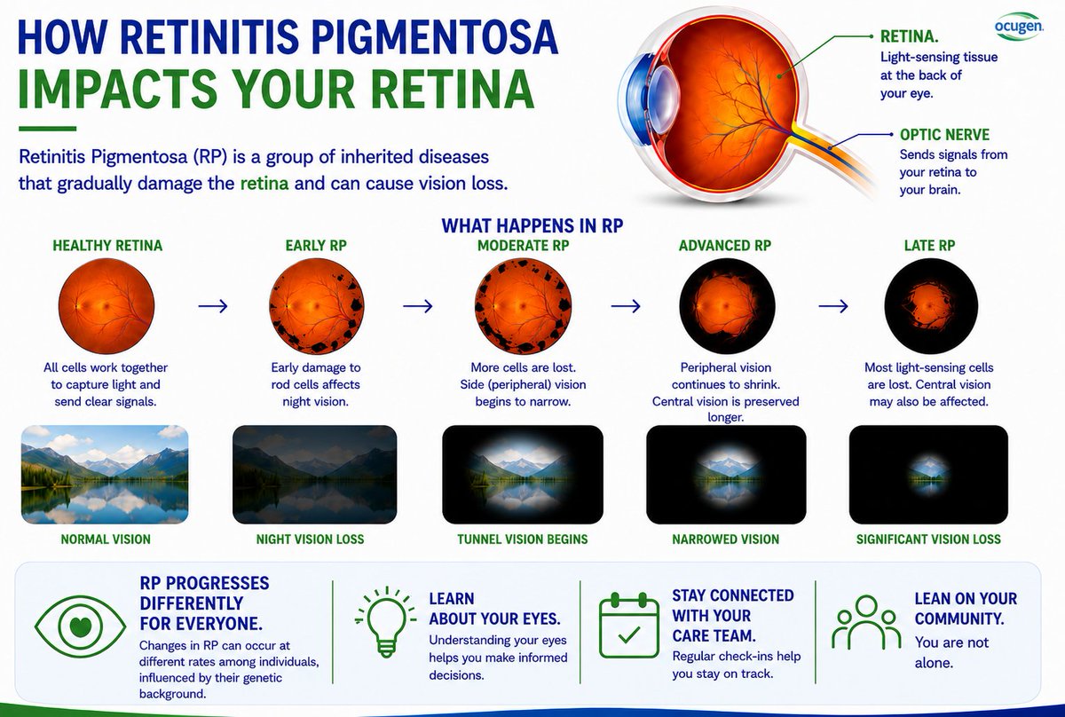 Ocugen's tweet photo. RP is a genetic condition that leads to progressive vision loss over time. #OCU400 is an investigational modifier #genetherapy designed as a potential one-time treatment for people living with RP. #RetinitisPigmentosa #Ocugen

Learn more: https://t.co/ykiBbfm4mp https://t.co/3yjjZX3JMA