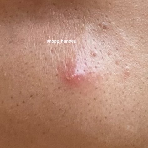 shopp_handeu's tweet photo. Tiap mendekati mens pasti ada aja jerawat yg muncul😭😌 ada yg relate gak sih?? https://t.co/mwFp6q8im5