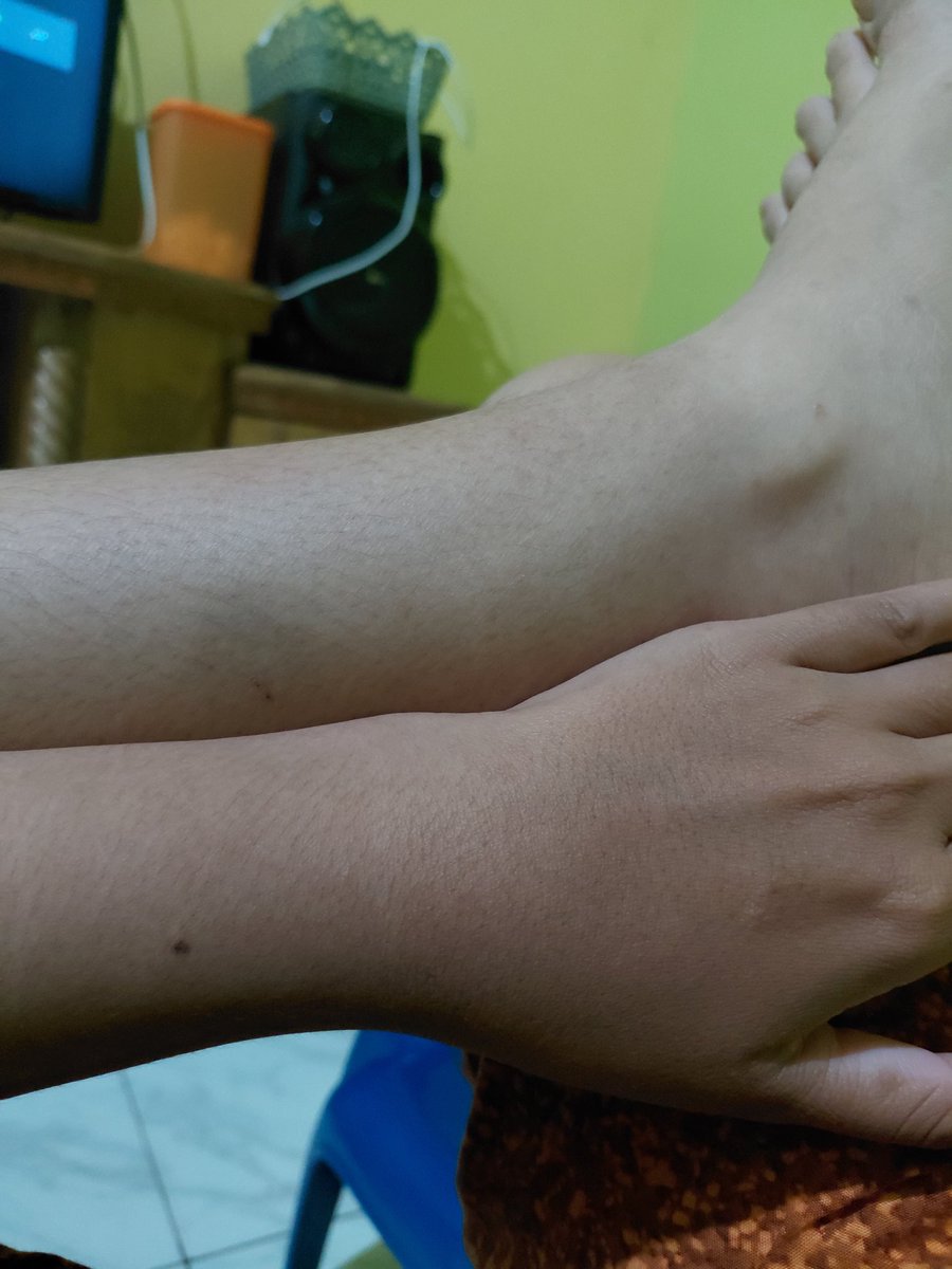 DeMutttt's tweet photo. Terangan kaki pada tangan,btw kaki w kok sering biru"yak. https://t.co/bSVkzYuTMz
