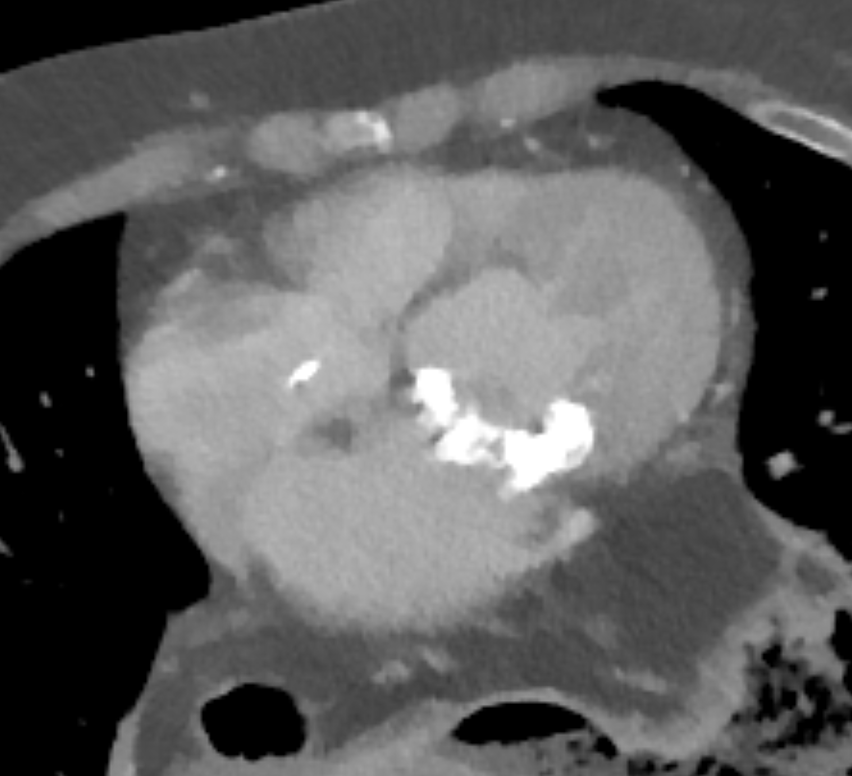 MaddiWulfeckMD's tweet photo. ๐งฉ Unknown Cardiac CT Challenge
Two cardiac CT images. Same patient.
๐
Left: Pre-procedure
๐
Right: 6 months later
๐ What procedure was performed, and why would you do it before a transcatheter mitral valve replacement (TMVR)?
#radres #radtwitter #medtwitter #casechallenge https://t.co/I8TN7UAhZR