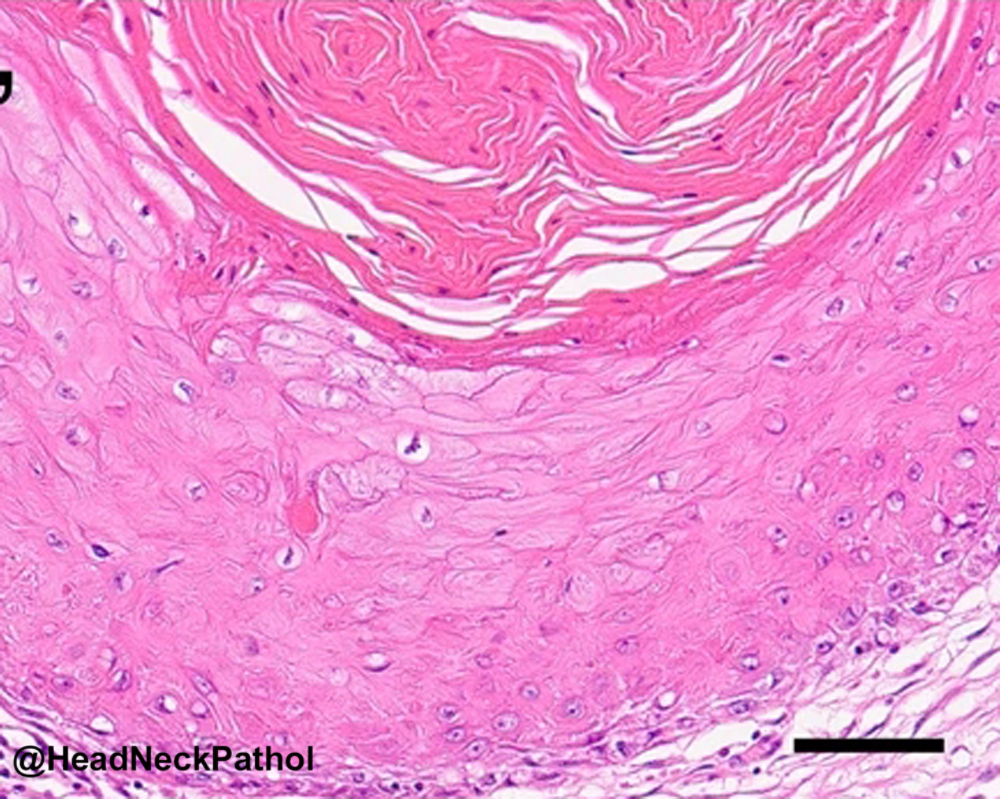 HeadandNeckPath's tweet photo. Genetic Landscape of Oral Carcinoma Cuniculatum and its Histological Mimics
Ono, Fukawa, Hirose, Hori, Motooka, Harada,  Morii, Toyosawa, Ishimaru &amp; Yamamoto
https://t.co/tnX31bVUYx
#HeadNeckPathol #HNPJ #HeadandNeckPath #Pathology #ENTPath #PathologyTweet https://t.co/p2WRsnhwf6