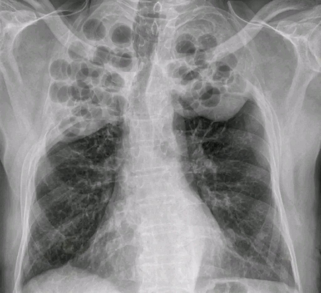 ajlkfad2333's tweet photo. X-ray Chest P/A view. 
Age:63Y 
C/C: Chest Pain,Cough,SoB.
Diagnosis? https://t.co/tV4BrSRkPS