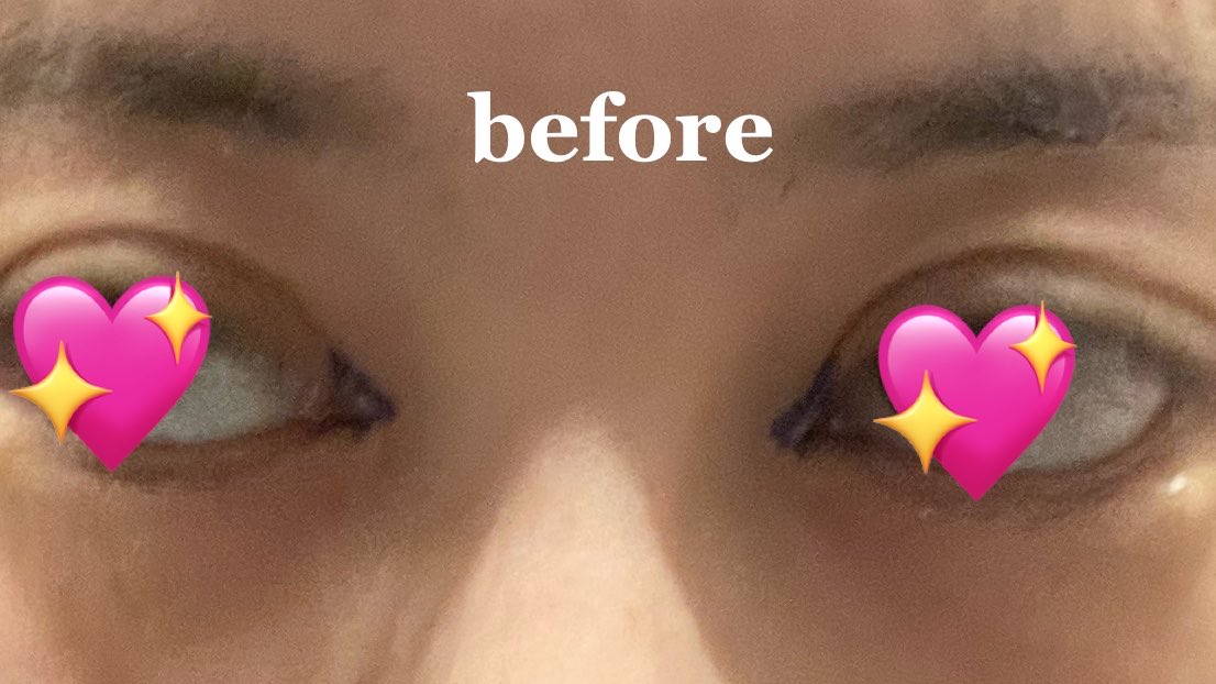 gaogao_inu's tweet photo. ビフォアフ  目頭切開 #インスタ #レポ #befor #after #目頭切開 #目元 #三日月法 #美容クリニック #美容整形  #ダウンタイム中 #経過記録 #術後 #dt0 https://t.co/BYcgROzkns
