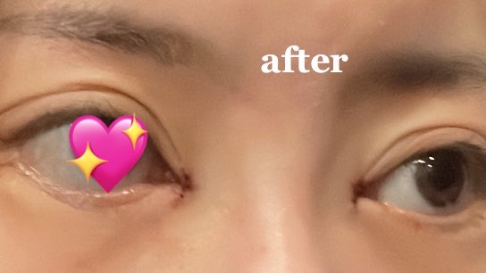 gaogao_inu's tweet photo. ビフォアフ  目頭切開 #インスタ #レポ #befor #after #目頭切開 #目元 #三日月法 #美容クリニック #美容整形  #ダウンタイム中 #経過記録 #術後 #dt0 https://t.co/BYcgROzkns