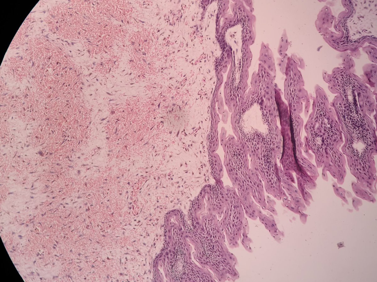 dr_vais's tweet photo. HISTOPATHOLOGY CASE :-
A 9-year-old male with a long-standing midline neck swelling near the hyoid bone underwent a successful Sistrunk procedure. https://t.co/HIN7y1a4km