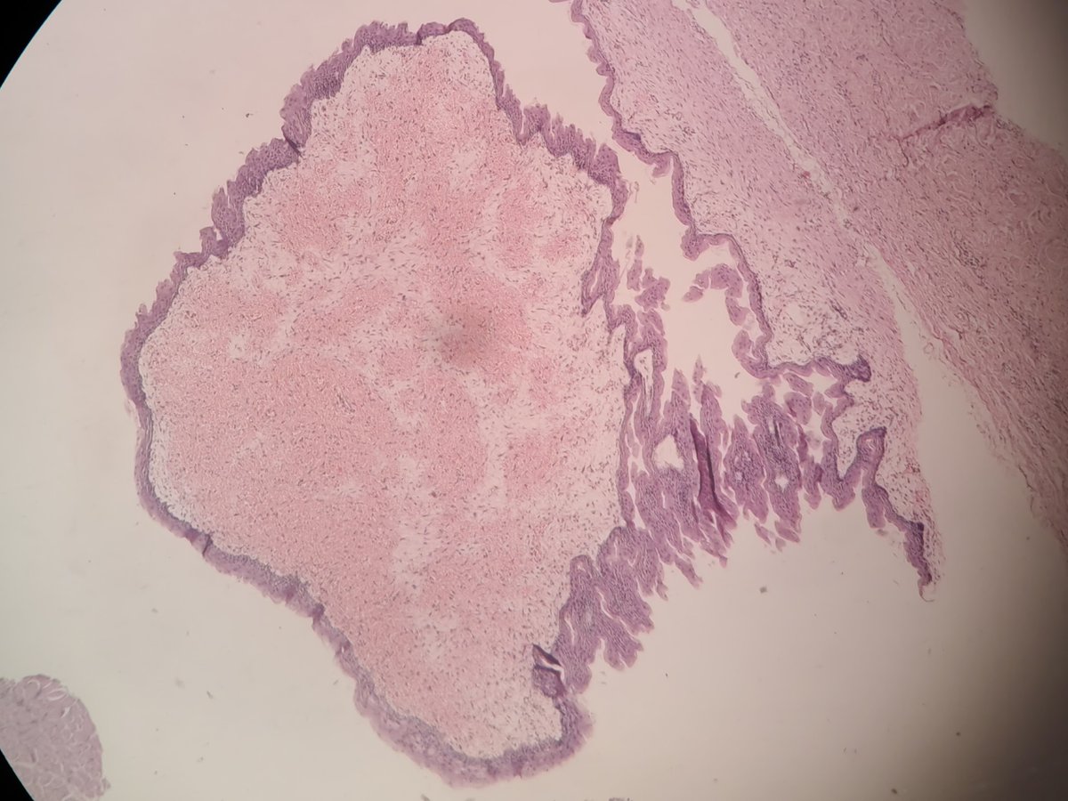 dr_vais's tweet photo. HISTOPATHOLOGY CASE :-
A 9-year-old male with a long-standing midline neck swelling near the hyoid bone underwent a successful Sistrunk procedure. https://t.co/HIN7y1a4km