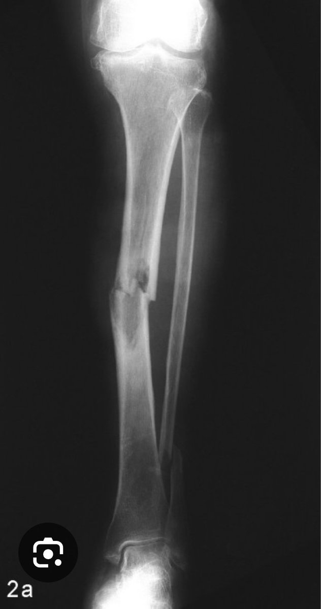 UyanikMehmetS's tweet photo. An imaginary Case:
40 y/o Female presented w/ fracture of the R tibia
🧪 demonstrated pancytopenia
BM biopsy &amp; 🩻 ⤵️
Dx &amp; Tx? https://t.co/Wpzwz8I6pJ